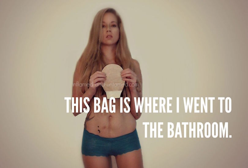 graphic of woman in underwear holding ostomy bag