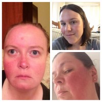 Photos of three women showing examples of rosacea