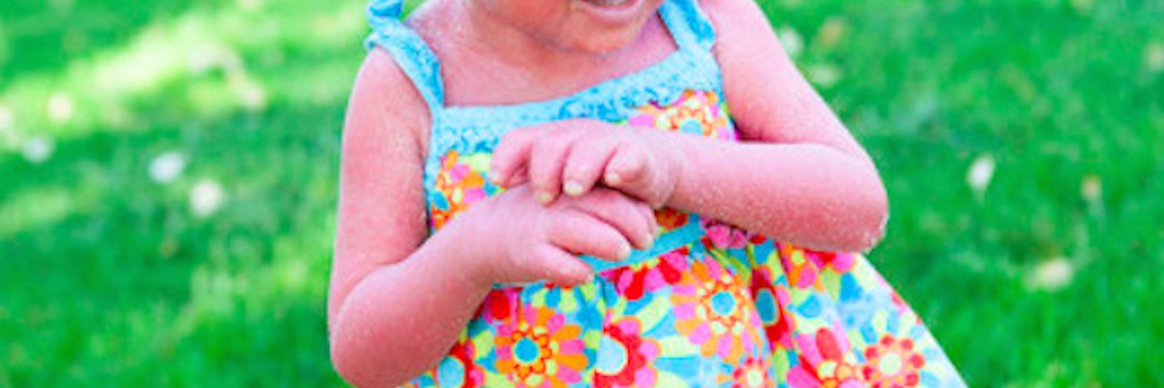 How I Answer When My Daughter With Ichthyosis Asks If She Looks Pretty Small girl with skin disorder looks away from camera as she stands on green grass on a sunny day