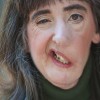 A woman with facial paralysis smiles for camera