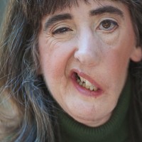 A woman with facial paralysis smiles for camera