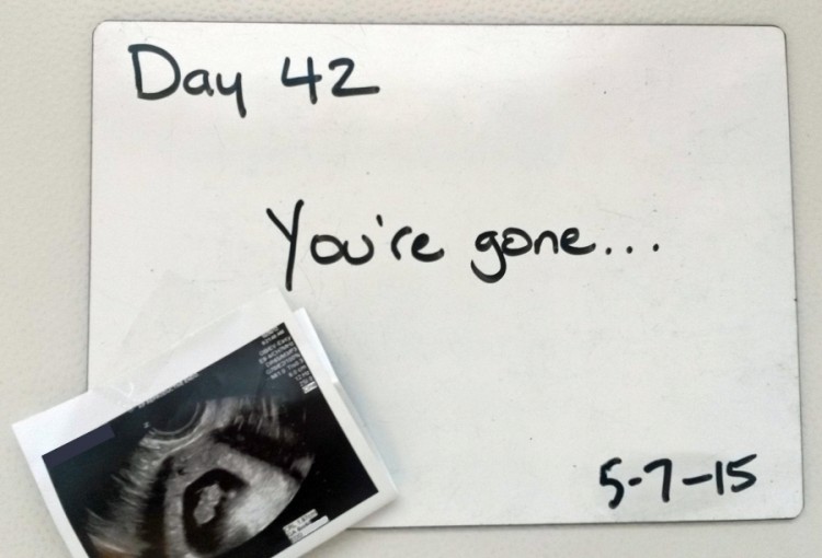 picture of ultrasound next to whiteboard that says 'day 42: you're gone...'