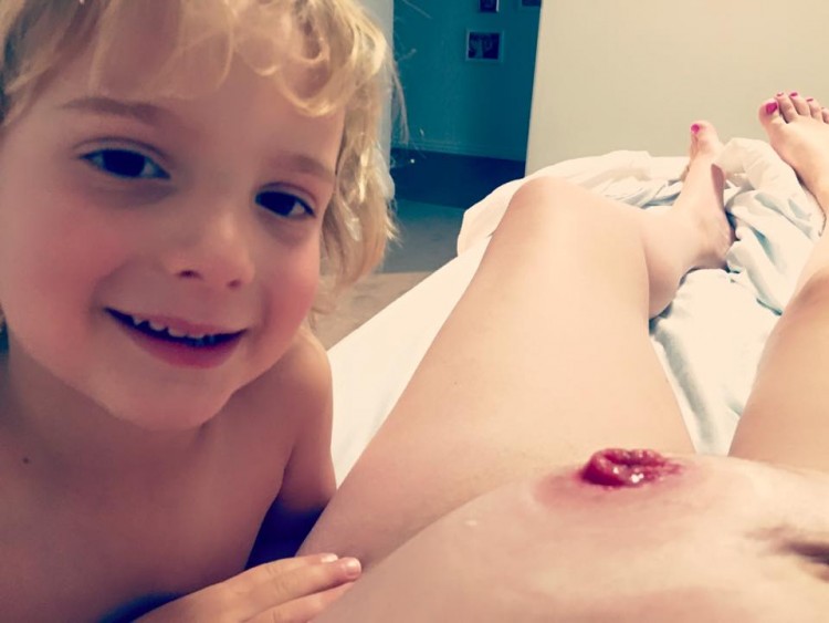 Miller's son, Lukas and her stoma. 