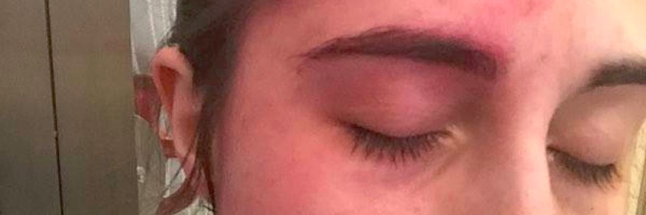 Letter to Doctor Who Doesn't Understand Complex Regional Pain Syndrome red face of woman with CRPS