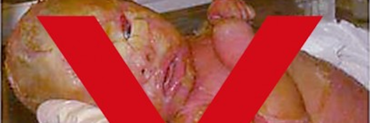 Why You Shouldn't Share Viral Memes of Babies With Rare Disorders Child with rare disease