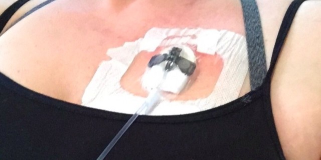 When People Misunderstand Your Invisible Illness a port in a patients chest