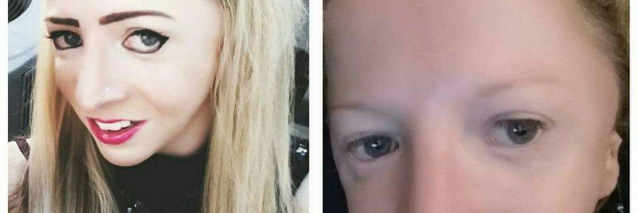 Woman With Treacher Collins Auditions for 'America's Next Top Model' split screen of woman on the left with makeup and on the right without