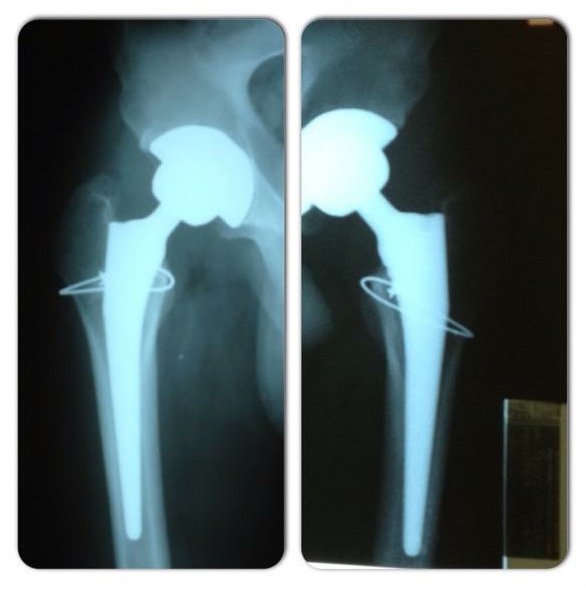 hip replacement x-ray