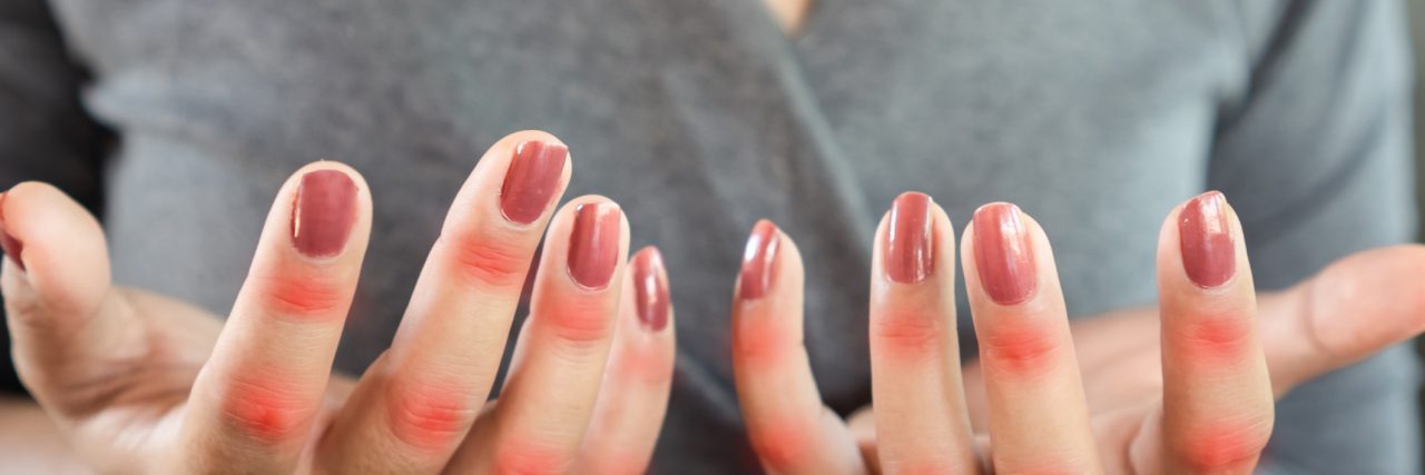 To the Psoriasis I've Lived With for the Last 28 Years White woman's hands with dark pink nail polish. Her finger joints are highlighted in red.