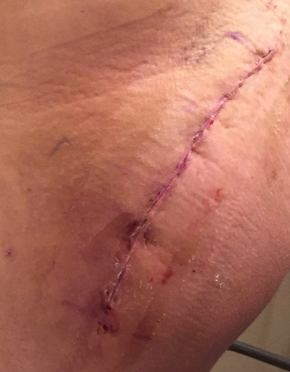 scar from surgery on man's hip
