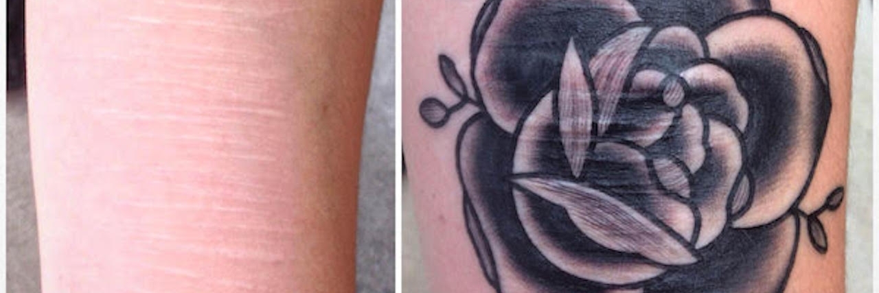 A woman's arms before and after her tattoo. On the left shows an arm with scars. On the right the scars are covered with a rose.