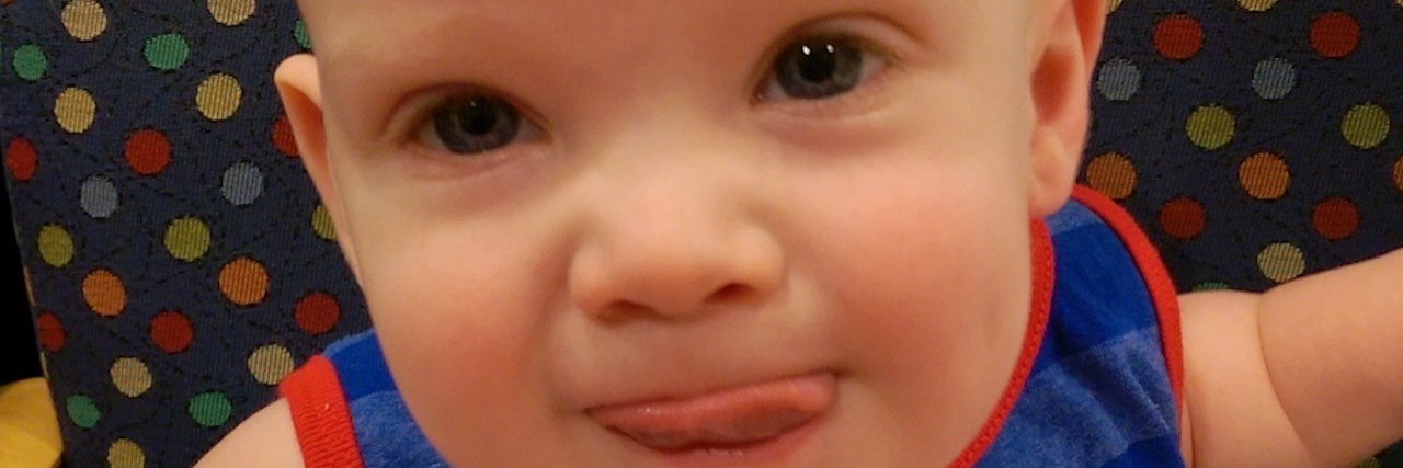 Amniotic Band Syndrome and Encephalocele: Defects Don’t Define My Son