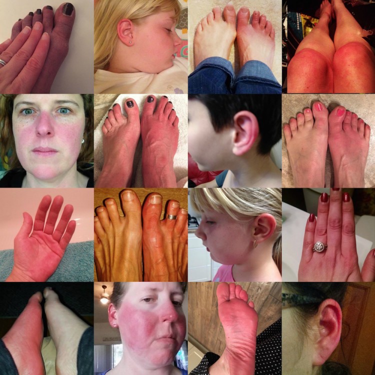 Photos of hands and feet and faces during EM flares