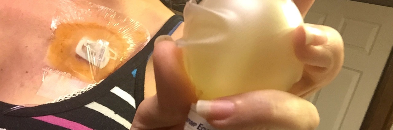 Photos of How I Really Look With Chronic Illness woman with chest port holding bottle of medication