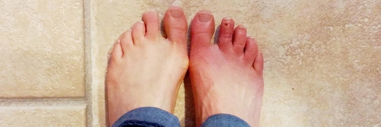 'sunburned feet' that are actually a flare up