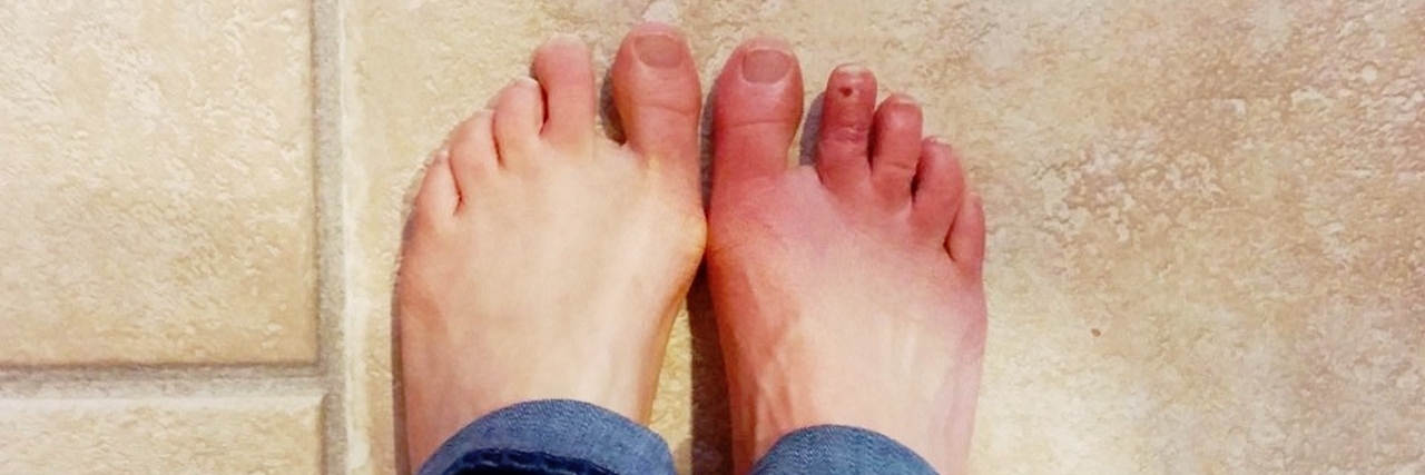 Responding to People Who Think My Erythromelalgia Flare Up Is Sunburn 'sunburned feet' that are actually a flare up