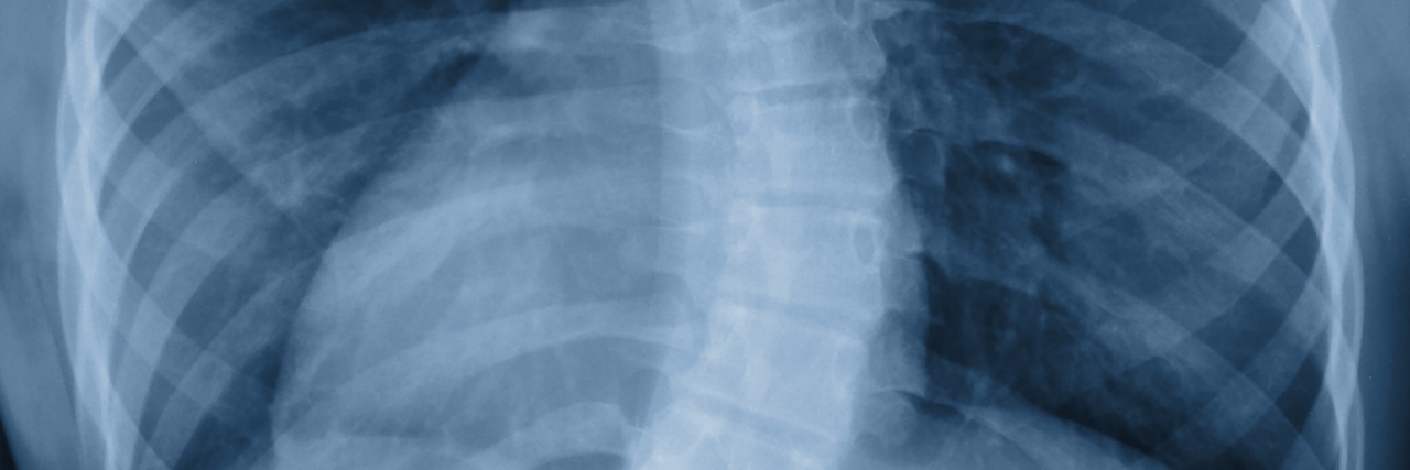 Scoliosis film x-ray