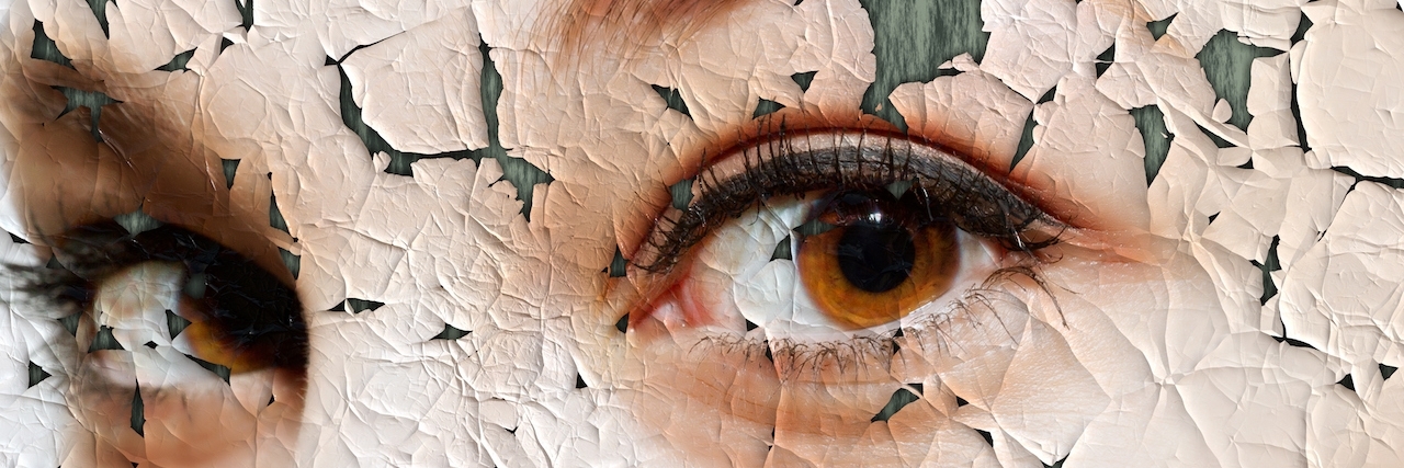 What Eczema Is Really Like for Me face covered with cracked surface