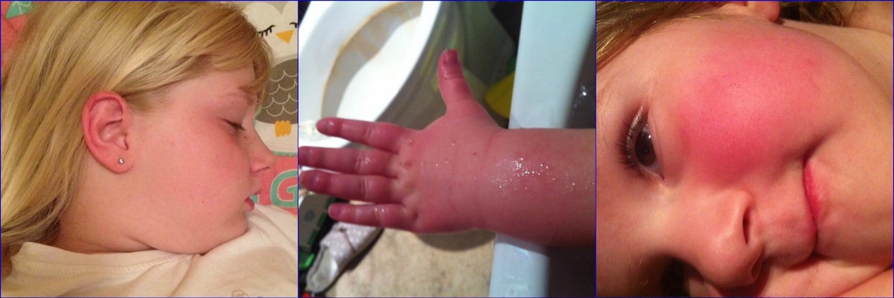 What It's Like Living With Erythromelalgia Children with EM