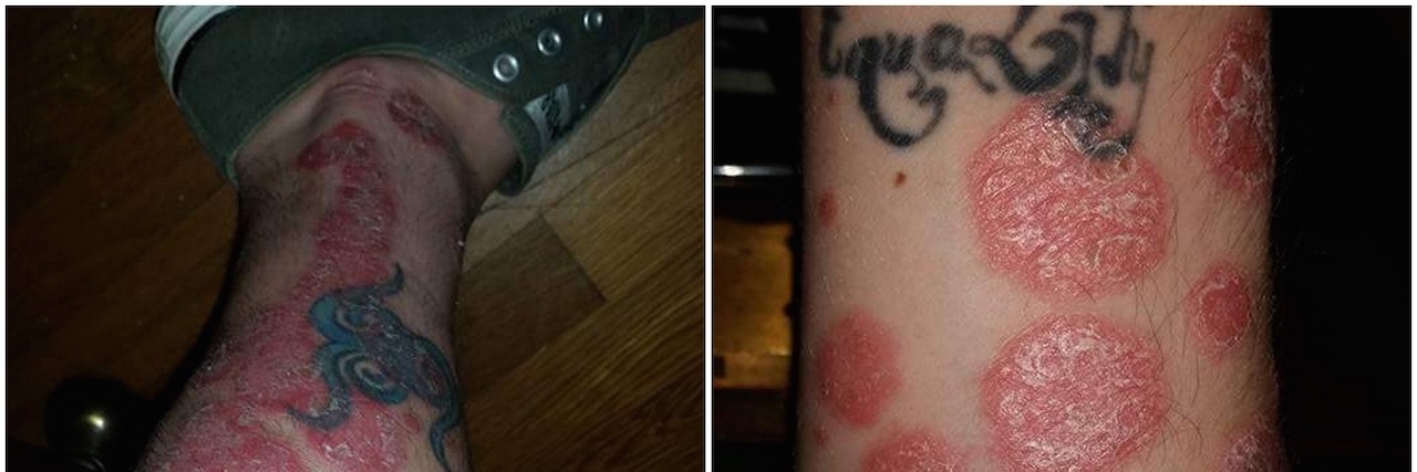 two photos of psoriasis on arm and leg