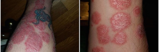 My Diagnosis and Treatment for Psoriasis | The Mighty