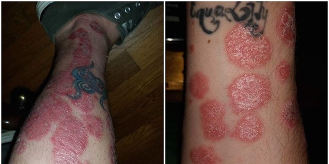 two photos of psoriasis on arm and leg