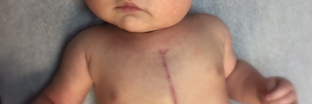 baby with heart surgery scar