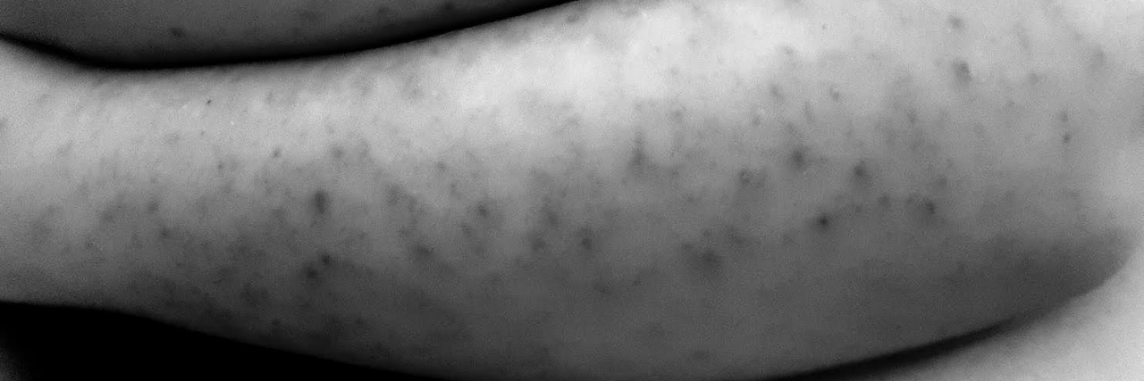 arms covered with scars from dermatillomania