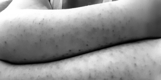 arms covered with scars from dermatillomania