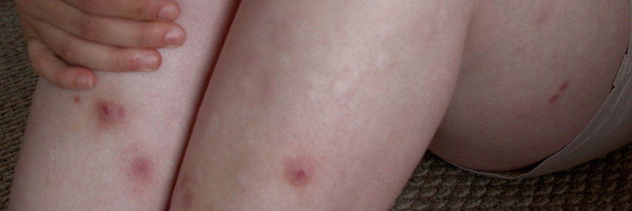 Dermatillomania: A Letter to the Woman Who Stared at My Legs A photo of the author's legs