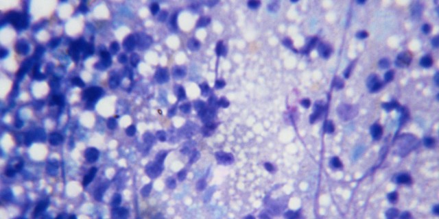 My Reflections After a Bone Marrow Biopsy Microscopic Image of Bone Marrow Cells Dividing