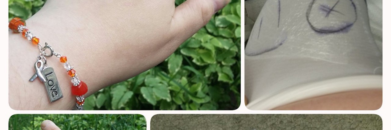 Living With Amniotic Band Syndrome of the Hands and Feet Brittany's hands modeling her jewelry