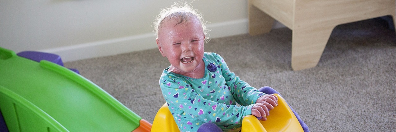 What to Know About Staring When Parenting a Child With Ichthyosis Courtney's daughter riding a toy car