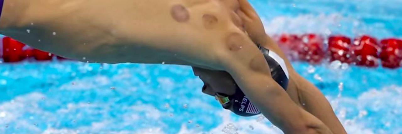 Cupping for Chronic Pain: Don't Call It a 'Fad' michael phelps cupping