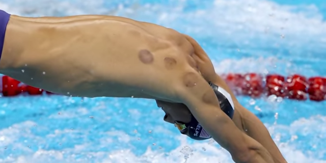 michael phelps cupping