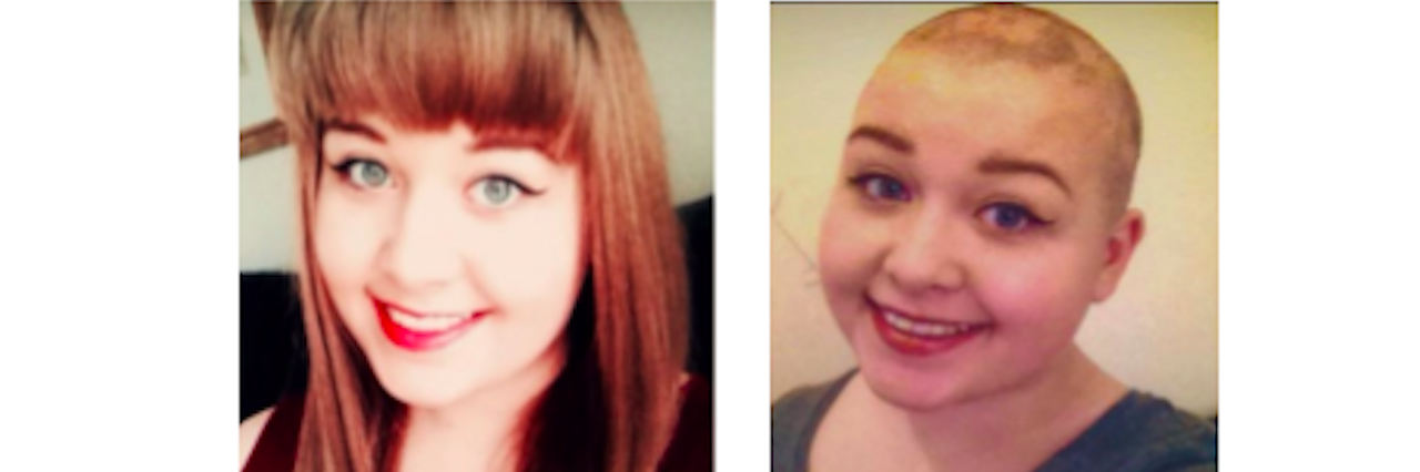 Trichotillomania and Choosing to Shave My Head before and after of woman who shaved her head