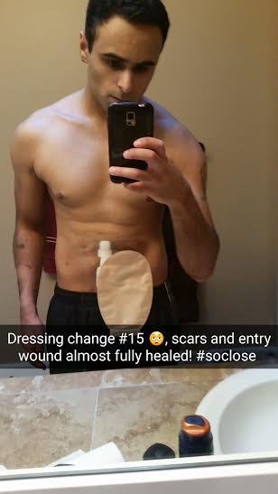 selfie of man showing is ostomy bag