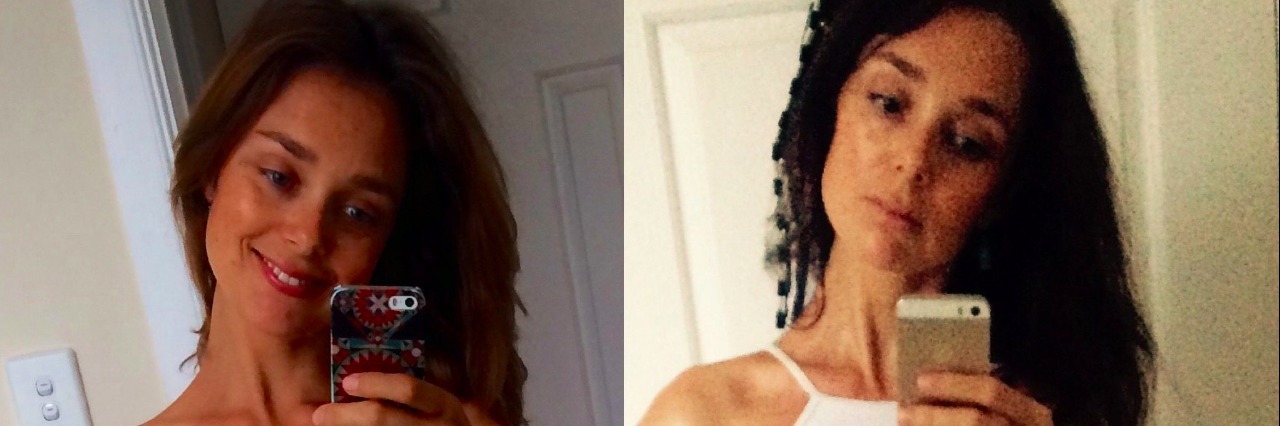 When I Didn't Realize How Bad My Crohn's Disease Symptoms Were before and after surgery selfies of sylvia