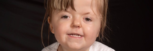 little girl with apert syndrome