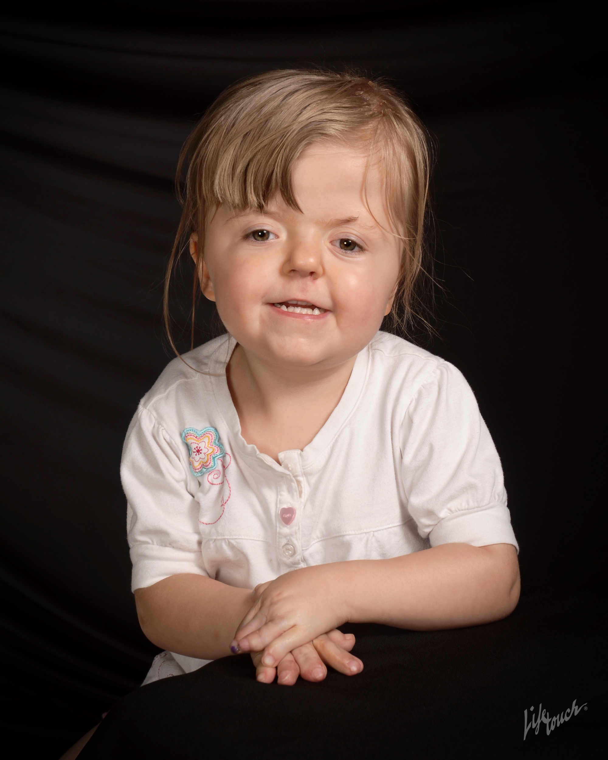 little girl with apert syndrome