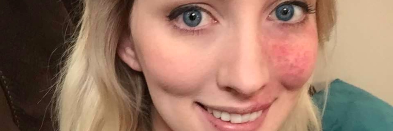 Growing Up With a Facial Birthmark: What I've Learned The author, a woman with a port-wine stain birthmark