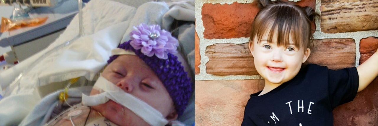 3 Life Lessons I've Learned From Down Syndrome and Alopecia