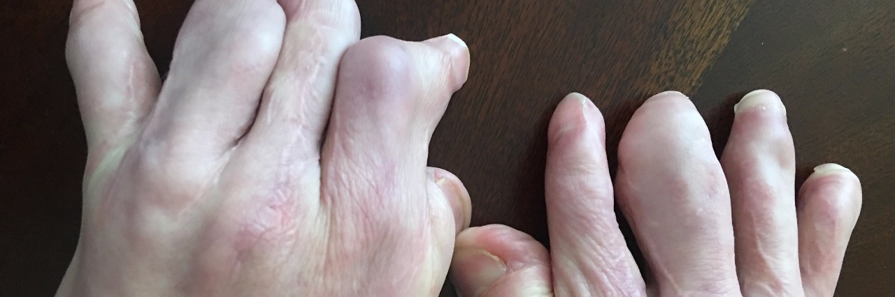 Feeling Self-Conscious About Scars With Apert Syndrome LIsa's son's hands