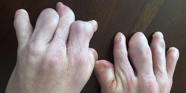 When My Son Said He Didn't Want Others to See His Scars LIsa's son's hands