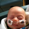 baby with down syndrome with breathing tube in