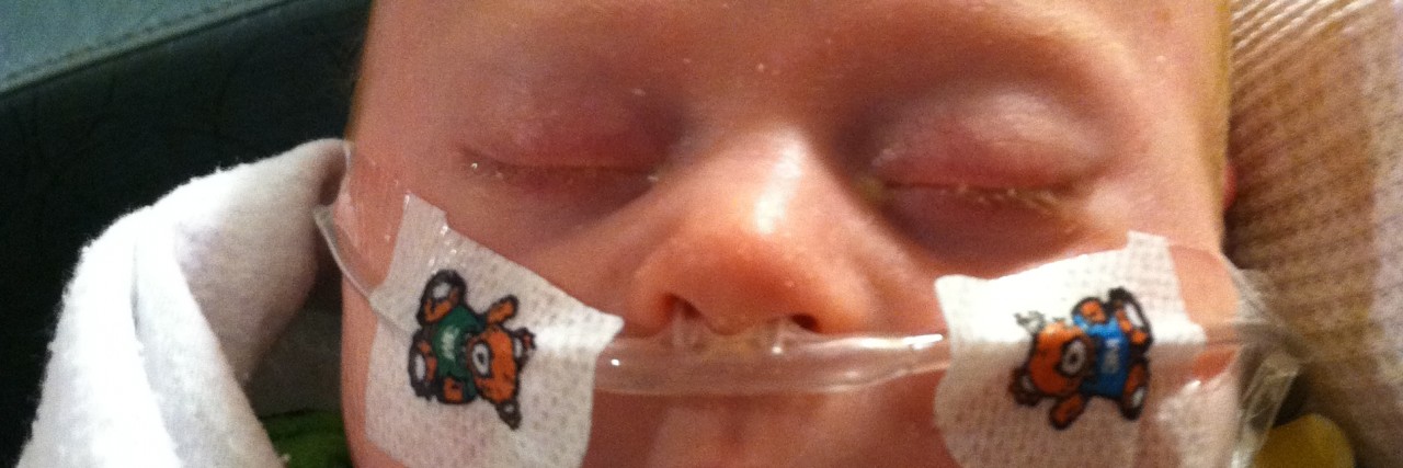 Dealing With the Medical Challenges That Can Come With Down Syndrome baby with down syndrome with breathing tube in