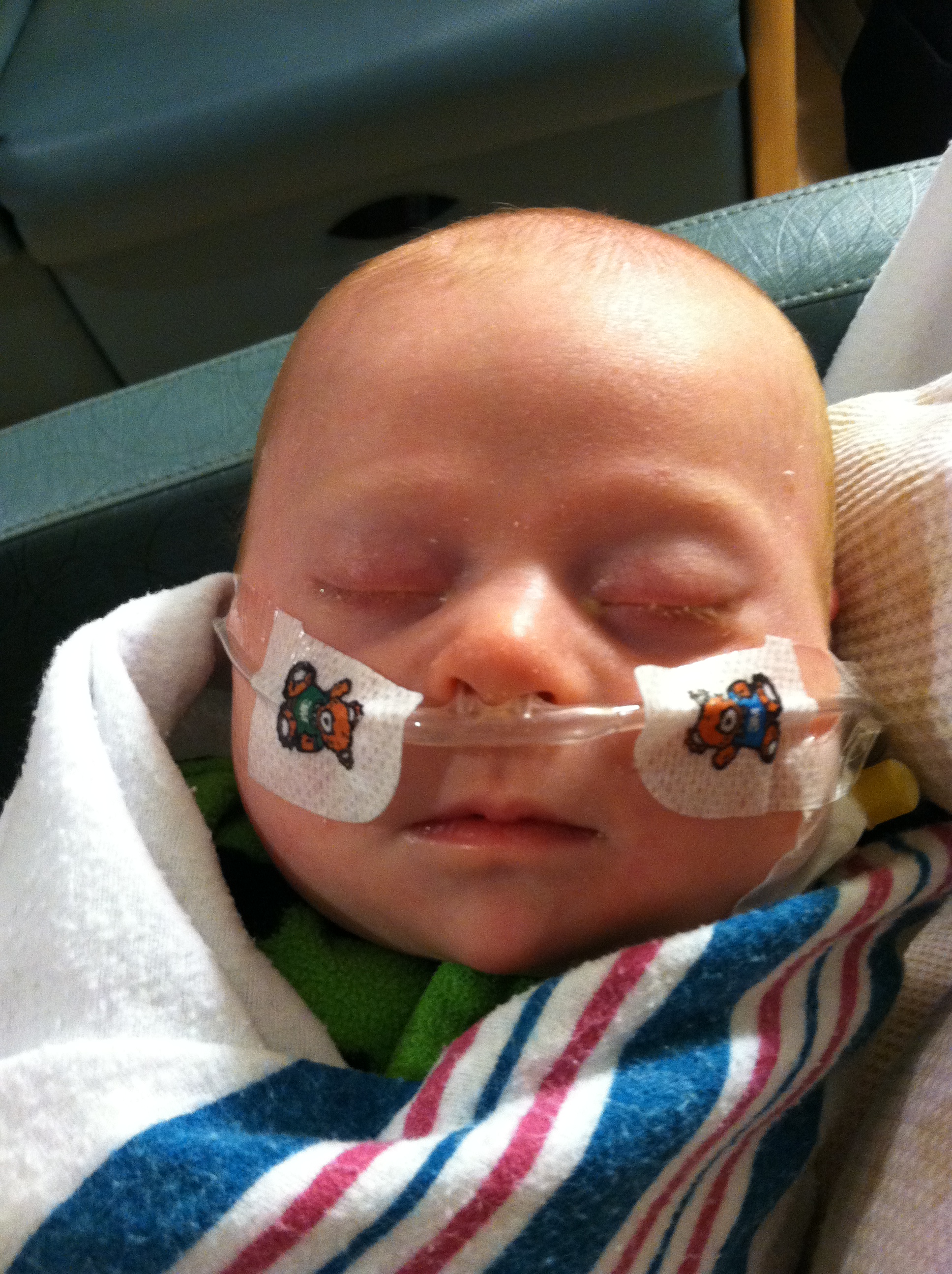 baby with down syndrome with breathing tube in