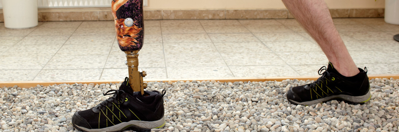 Insurance Limitations Deny Prosthetics to Amputees Prosthetic leg.