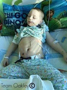 little boy with prune belly syndrome after surgery