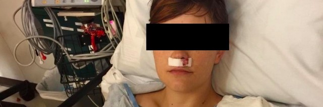 woman after nose surgery